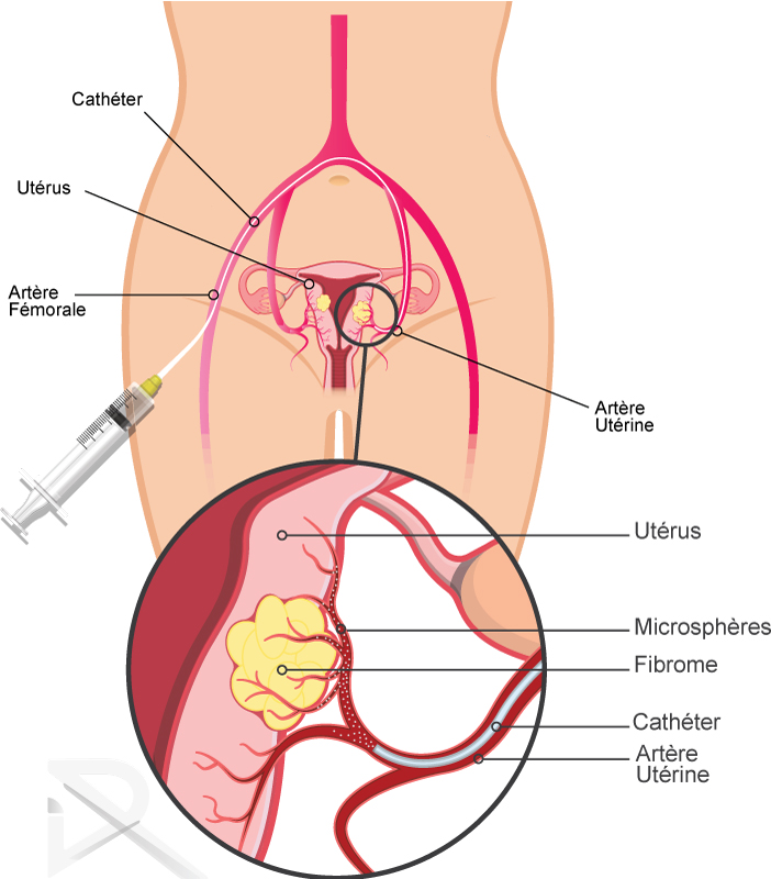 embolisation fibrome uterin