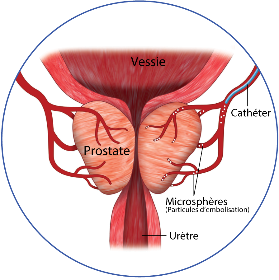 Adénome de la prostate: un traitement mini-invasif par embolisation