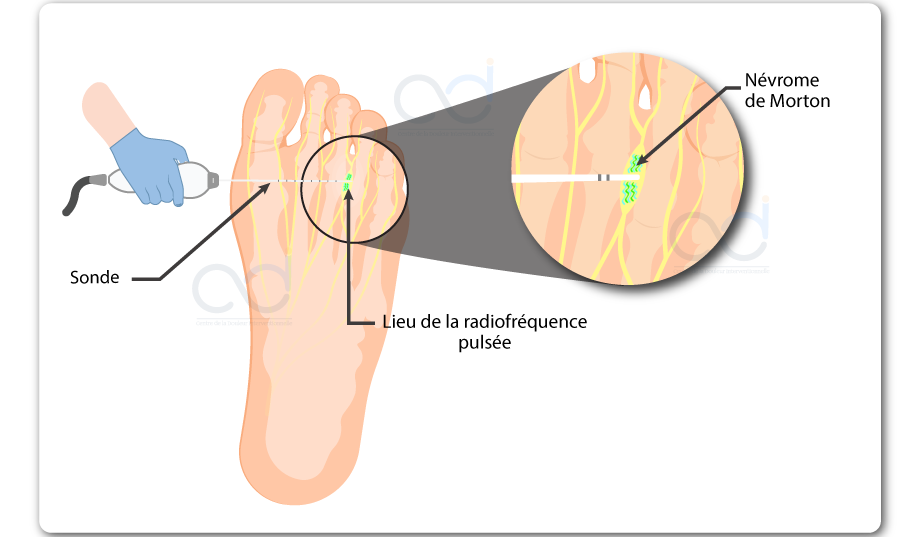 Schéma de la radiofréquence pulsée du névrome de Morton : vue de la plante du pied, une sonde introduite sur le côté de l’avant-pied est placée au contact du névrome ; en agrandissement, les impulsions sont figurées en vert autour du nerf.