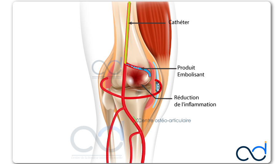 Arthrose du genou : Nouveau traitement - Centre de la douleur