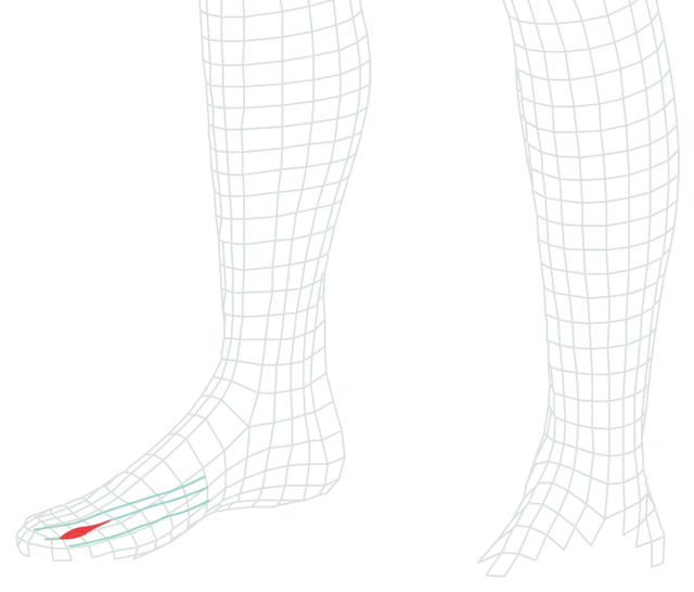 Schéma des jambes en maillage montrant les nerfs de l’avant-pied en vert et, en rouge, le névrome de Morton : un épaississement du nerf situé entre deux métatarsiens, près de la base des orteils.
